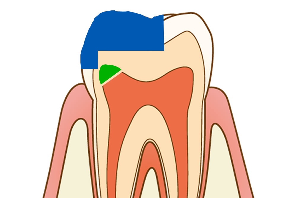 第二象牙質の形成