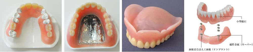 豊富な入れ歯
