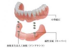 磁石義歯
