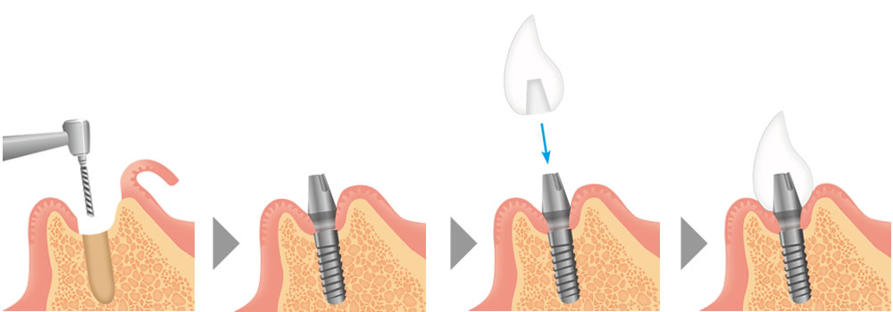 インプラント治療の手順