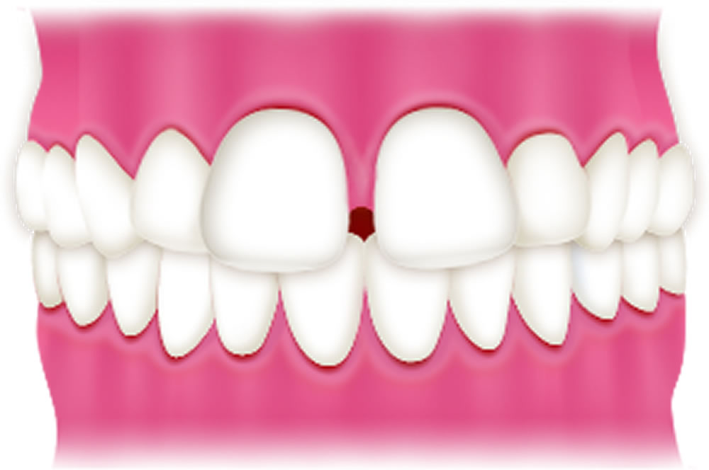 すきっ歯(空隙歯列)