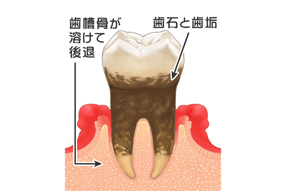 歯周炎